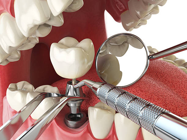 Best Emergency Dental Extractions in Germantown, IL